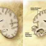 A healthy brain (left) and a brain in the advanced stages of Alzheimer’s, with visible cell loss.