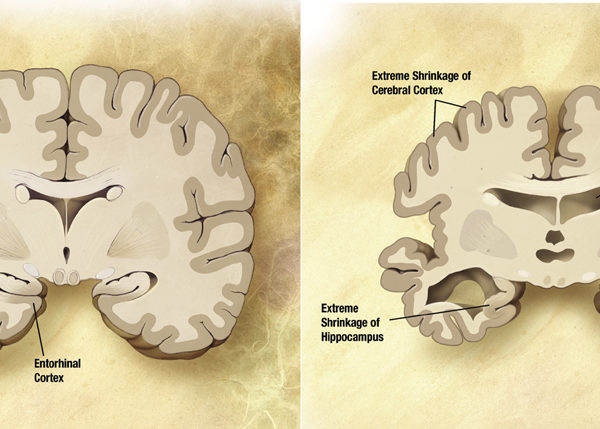 A healthy brain (left) and a brain in the advanced stages of Alzheimer’s, with visible cell loss.