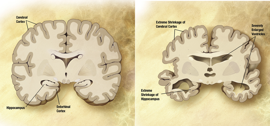 A healthy brain (left) and a brain in the advanced stages of Alzheimer’s, with visible cell loss.