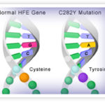 The C282Y gene mutation.
