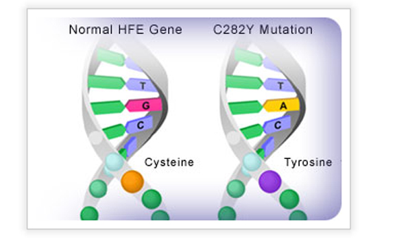 The C282Y gene mutation.