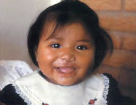 <em>Joselin Serrano Rodriguez after her surgery by Operation Smile doctors.</em>