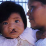 Joselin Serrano Rodriguez of Bolivia before her surgery by Operation Smile doctors.