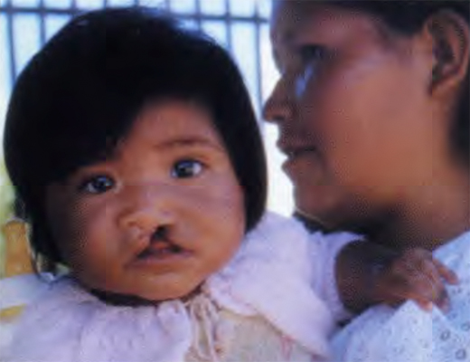 Joselin Serrano Rodriguez of Bolivia before her surgery by Operation Smile doctors.